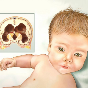 Hidrosefali Hastaları Yürüyebilir mi? 