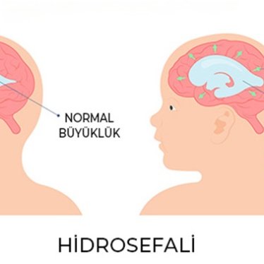 Hidrosefali Hastalarında Yürüme Mümkün mü?