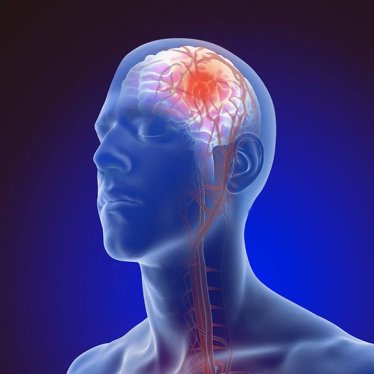 İnme Geçirdiğinizi Nasıl Anlayabilirsiniz?