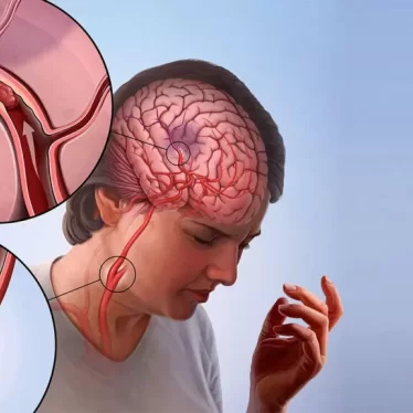 İnme Nasıl Anlaşılır? Belirtileri Nelerdir?