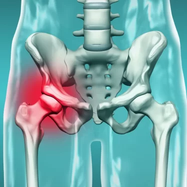 Kalça Kırığı Sonrası Fizik Tedavi  