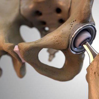 Kalça Protezi Sonrası Hastalarda Fizik Tedavi Süreci