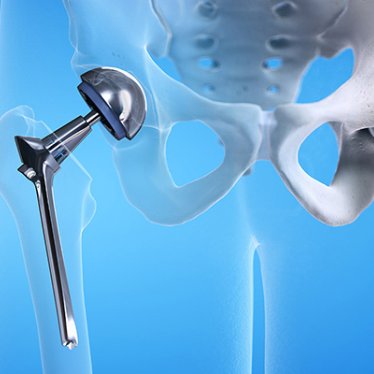 Kalça Protezi Sonrası Hızlı İyileşme İçin Yapılması Gerekenler