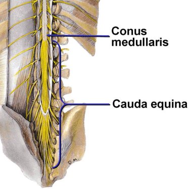 Kauda Equina Sendromu: Ne Zaman Tehlikelidir?