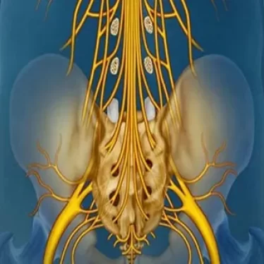 Kauda Equina Sendromunda Fizik Tedavi Süreci
