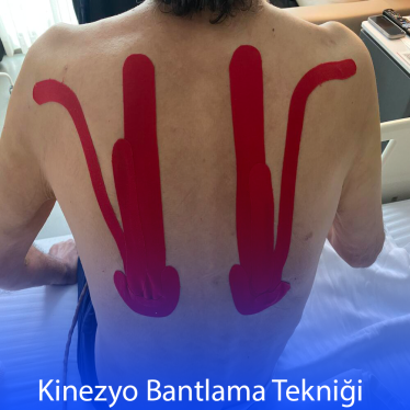 Kinezyobantlama nedir ?
