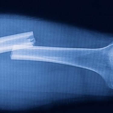 Kırık Sonrası Fizyoterapi ve Rehabilitasyon