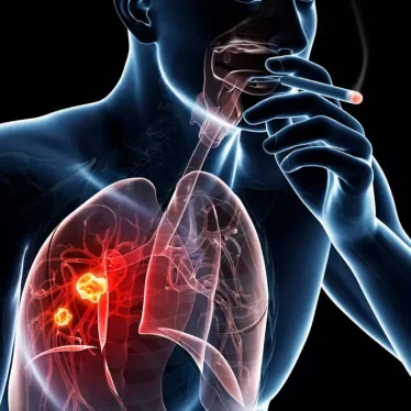 KOAH Hastalarında Fizik Tedavinin İyileşme İçin Yararı