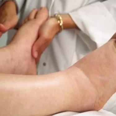 Lenfödem İyileşir mi? Nasıl Tedavi Edilir?