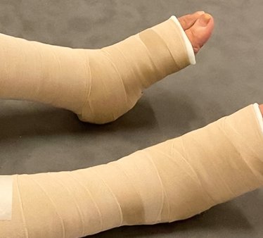 Lenfödem Nedir? Nasıl Tedavi Edilir?