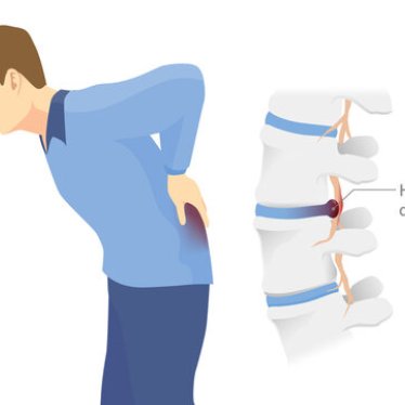 Lumbal Disk Hernisinde (Bel Fıtığı) Robotik Destekli Rehabilitasyon