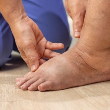 Meme Kanseri Sonrası Lenfödem Tedavisi