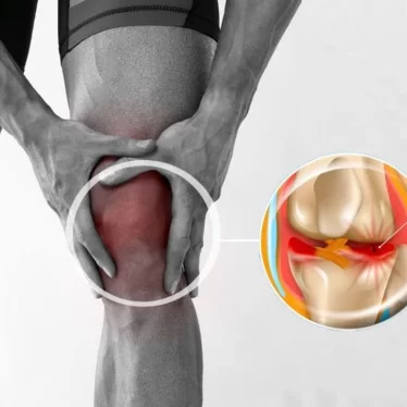 Menisküs Ameliyatı Sonrasında Robotik Rehabilitasyon Kullanılır mı?