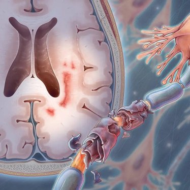 MS Hastalığında Fizik Tedavi Uygulamaları: Multiple Sklerozda Rehabilitasyon