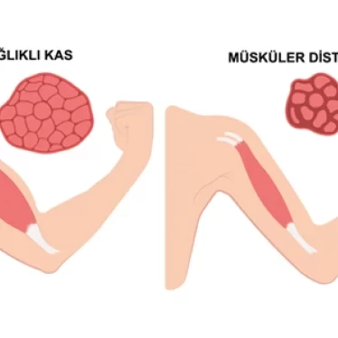 Musküler Distrofi Hastalarında Rehabilitasyon: Yaşam Kalitesini Artırmanın Yolları