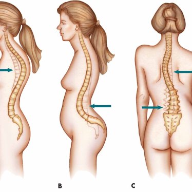 Omurga Eğriliği İçin En Etkili Fizik Tedavi Yöntemleri