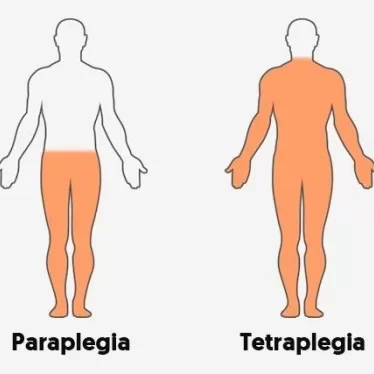 Omurilik Felcinde (Omurilik Yaralanmalarında) Fizik Tedavi ile Yürüme Mümkün Mü?
