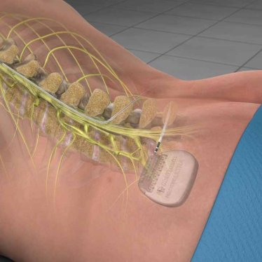 Omurilik Pili Kullanımı ve Süreç