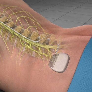 Omurilik Pili Nedir? Omurilik Pilinin Felçte Kullanımı