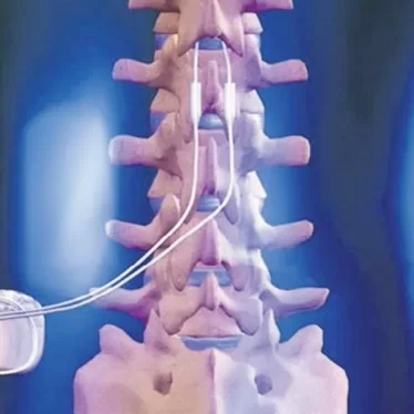 Omurilik Pili Takılan Hastalarda Fizik Tedavi