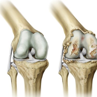 Osteoartrit Ve Fizyoterapi 