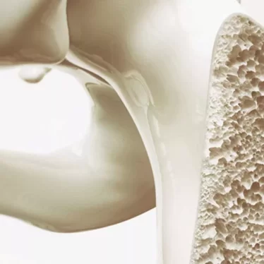 Osteoporoz Hastalarında Egzersizle Kırık Riskini Azaltmak