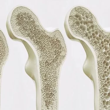 Osteoporoz Kadınlarda Daha Mı Sık Görülür?