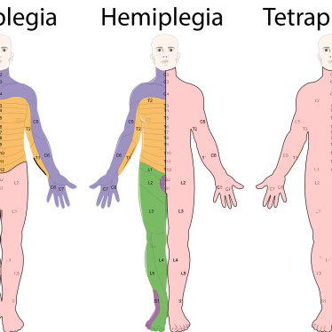 Parapleji ve Tetrapleji Hastalarında Yaşam Kalitesini Artırma Yöntemleri
