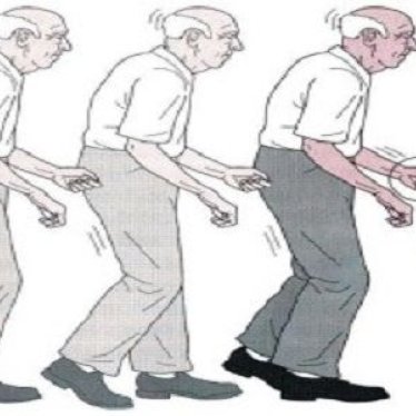 Parkinson Hastalarında Exoskeleton Tedavisinin Faydaları