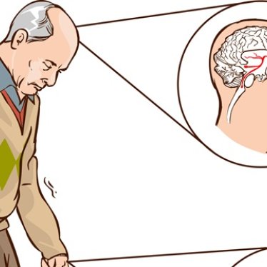 Parkinson Hastalarında Robotik Rehabilitasyon