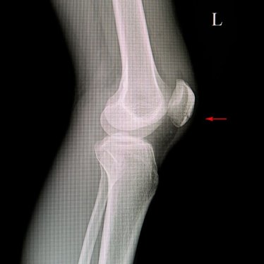 Patella Kırıklarından Sonra Robotik Rehabilitasyon Uygulanır mı?