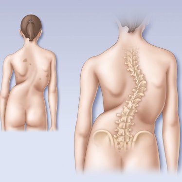Skolyozda Fizik Tedavi ile Omurga Eğriliği Kontrol Altına Alınabilir mi?