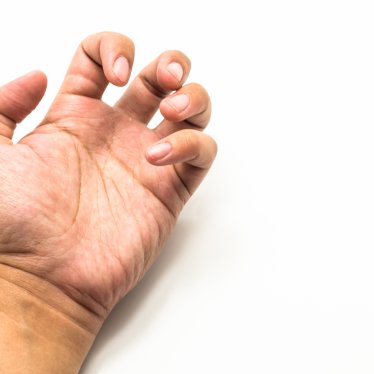 Spastisite Nedir? Fizik Tedavi ile Nasıl Yönetilir?
