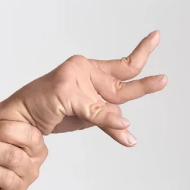 Spastisite Yönetiminde Günümüzde Modern Fizyoterapi Yaklaşımları