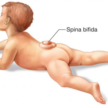 Spina Bifida ile Yaşamak: Günlük Hayatta Karşılaşılan Zorluklar ve Çözümler