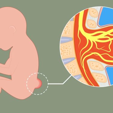 Spina Bifida Nedir? Belirtileri ve Tedavi Süreci Nasıl İşler?