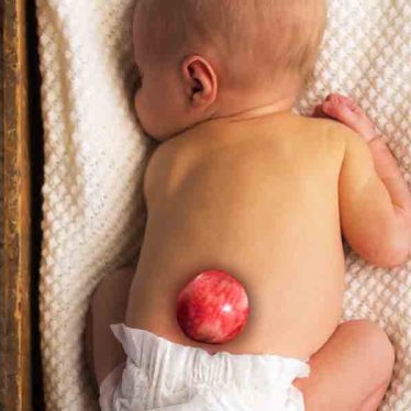 Spina Bifida ve Fizyoterapi 