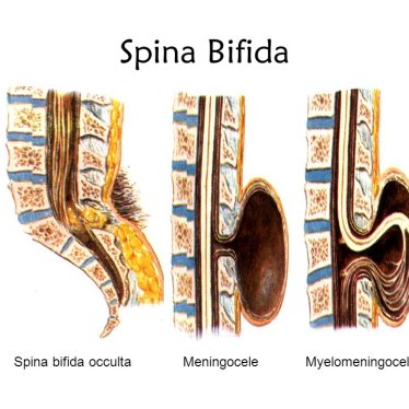 Spina Bifida ve Fizyoterapi’de Egzersiz