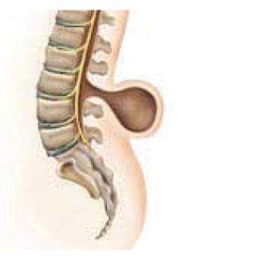 Spina Bifidada Robotik Rehabilitasyonun Önemi