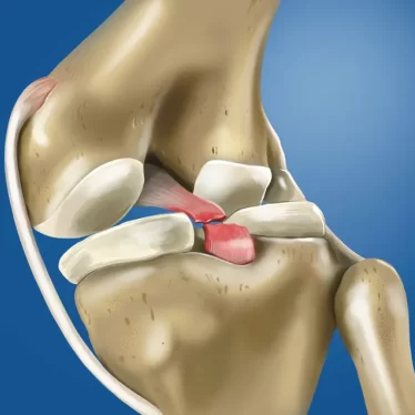 Spor Yaralanmalarında Hızlı ve Güvenli Geri Dönüş İçin Rehabilitasyon