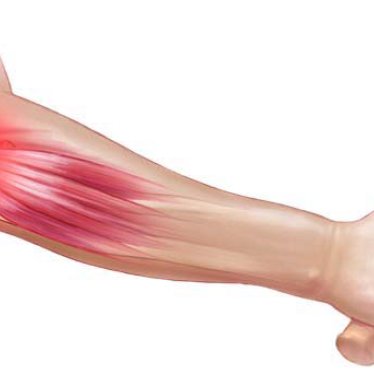 Tenisçi Dirseği: Fizyoterapi ve Rehabilitasyonun Rolü