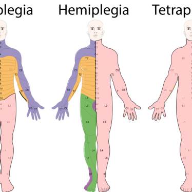 Tetraplejide Fizik Tedavinin Yeri