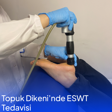 Topuk Dikeni’nde ESWT Tedavisi