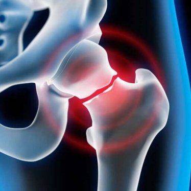 Yaşlılarda Kalça Kırıkları ve Fizik Tedavi ile Tedavisi